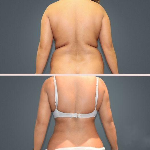 back lilipo vaser 71